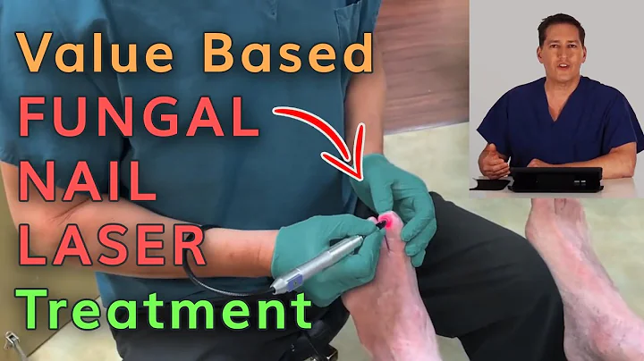 Value Based Fungal Nail Laser Treatment by Dr. Mic...