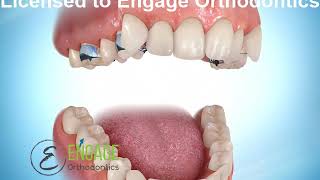 Distal Jet Appliance