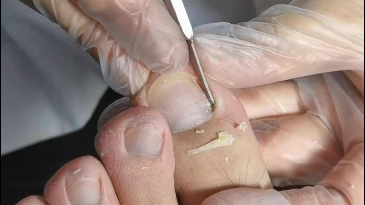 Pedicure How to cut your toenails. Ingrown nails removal for my client