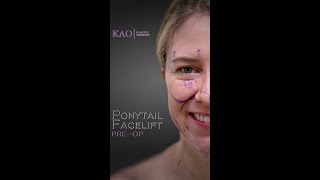 Ponytail Facelift and Revision Rhinoplasty  Aesthetic Facial Plastic Surgery Preop Consultation