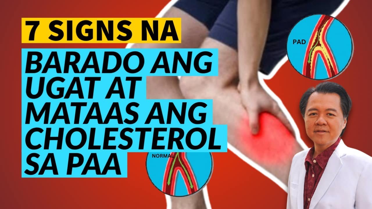 7 Signs na Barado ang Ugat at Mataas ang Cholesterol