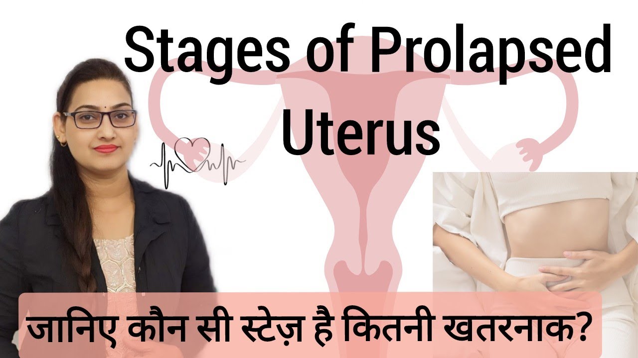 Different stages of Prolapsed Uterus