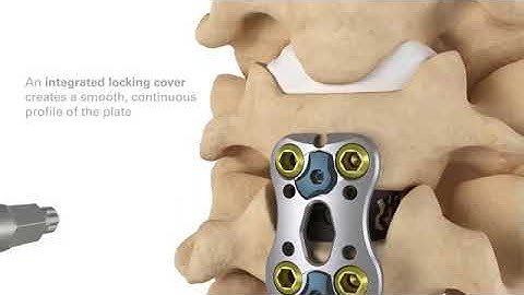 Nuvasive: ACP product animation