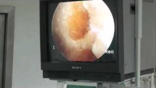 Uso de células madre en la reparación del cartílago articular