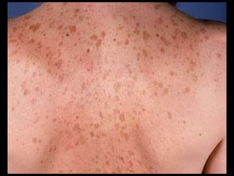 Eliminar manchas solares o marrones en la piel y cómo quitar manchas de la cara