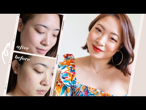 Trying Laser Skincare Treatment: Before/After, Preparation & Aftercare | Beauty Unboxed