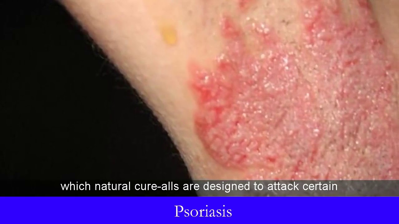 Psoriasis Groin Cure Youtube