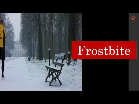 Frostbite |Homoeopathy and Health| Malayalam|