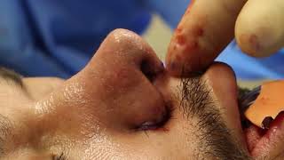 Weir Wedge Excision to Shrink Nostrils and Narrow the Nose