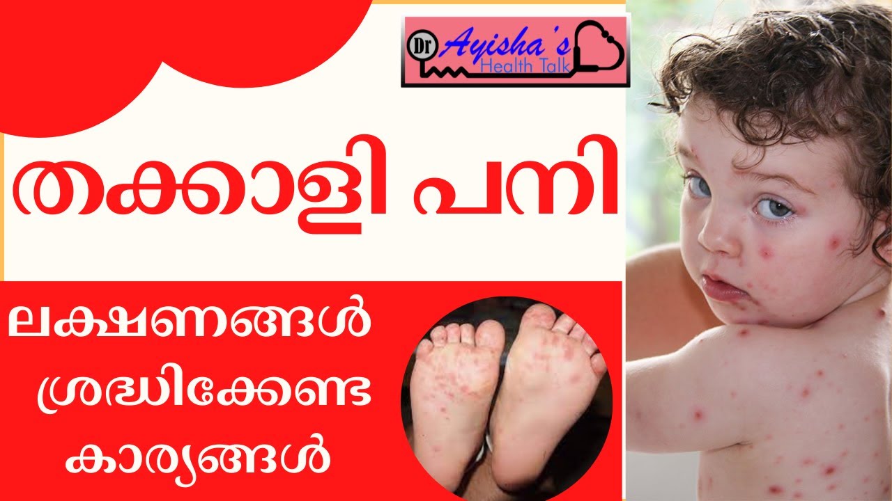 തക്കാളി പനി | ലക്ഷണങ്ങളും ശ്രദ്ധിക്കേണ്ട കാര്യങ്ങളും | HFMD