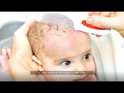 Video: 3 Ways to Overcome Cradle Cap