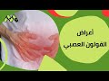 هل تعاني من هذه الأعراض قد يكون قولون عصبي هل تعاني من هذه الأعراض قد يكون قولون عصبي