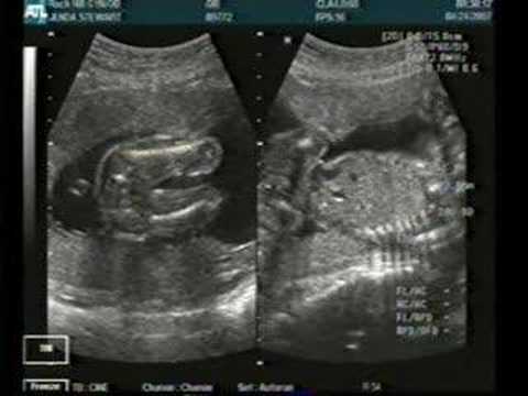 Ultrasound 5 Months Youtube Ultrasound 5 Months Youtube