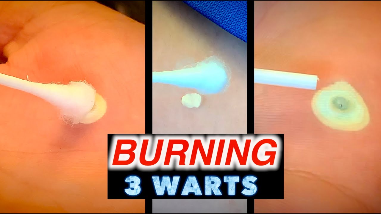 Burning Off 3 Big Warts With Liquid Nitrogen Dr Paul Youtube