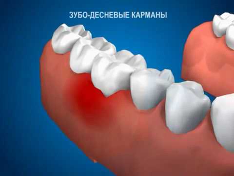 Зубо десневые  карманы. Когда в десне появляется отверстие (промежутки )куда может попадать пища