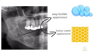 Ameloblastoma Part 1