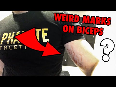 Video: Stretch Marks On Bicep