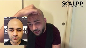 Scalp Micropigmentation Austin, Texas? SMP Hair Tattoo for Hairloss in Austin