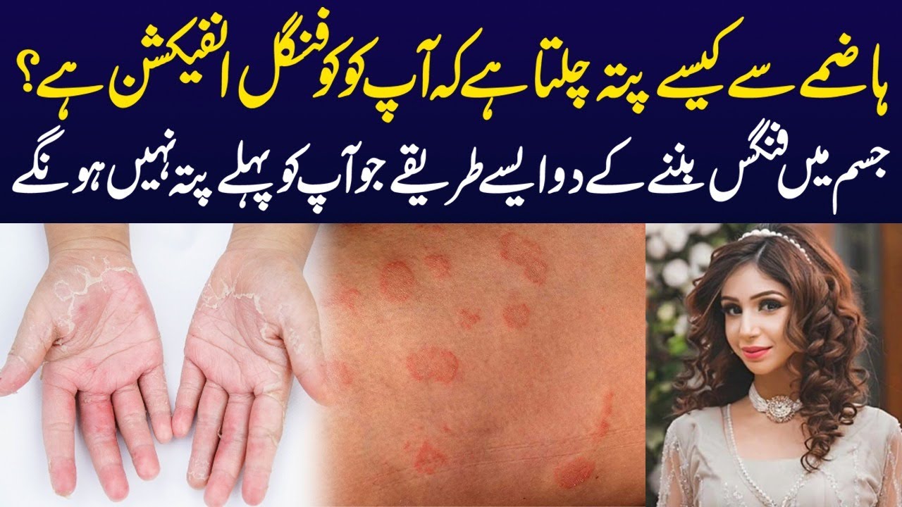 Digestion Se Fungal Infection Ka Kese Pata Chalta Hai? Dr Sahar