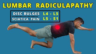 Lumbar Radiculopathy L4 L5  L5 S1 exercises for pain relief