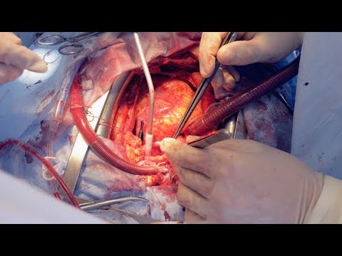 open-heart-surgery-process-2020