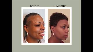 Great Hair Replacement Surgeons in Fort Lauderdale | Hair Transplant Surgery Fort Lauderdale
http://naturaltransplants.com/ Great Hair Replacement Surgeons in Fort Lauderdale | Hair Transplant Surgery Fort LauderdaleCALL 954-372-8824 for your free hair transplant consultation. No pressure sales tactics just good information to assist you in finding the best restoration solution for you. All our surgeons are licensed medical doctors with many years of experience practicing medicine. At Natural Transplants, Hair Restoration Clinic we only perform hair transplant surgery and nothing else.
Our hair transplant consultations are limited and appointments are needed to speak with one of our hair transplant surgeons. Then you will be able to speak with the doctor face-to-face either online or in person. Call and check availability now so you can ask the doctor anything about your goals and wants for getting a hair transplant.
Natural Transplants, Hair Transplantation Clinic. HUE (High-Yield Unit Extraction®). Hair Transplant Surgery. Call (844) 327-4247.
Dont expect any high-pressure sales techniques like the ones you get by calling the phone on the TV commercial. Getting a hair transplant is a big decision and you need to check around so do your research. Its a major commitment to change the way you look and when you choose your hair transplant surgeon, youll want the very best.
Hair Transplant Surgery Fort Lauderdale | Natural Transplants Before and After Hair Transplants at our hair clinics. Call us at (844) 327-4247 and speak with a hair transplant specialist and you will be happy to hear that we are not into high-pressure sales techniques. We dont need to as our work speaks for us and the results are outstanding. Youd probably like to know what the cost of a hair transplant?
If you are looking for a fuller, natural looking head of hair that will make you look and feel better, dont be concerned about the hair transplant costs. If you are considering a permanent hair loss solution and are worried about the cost of a hair transplant then relax as Natural Transplants has convenient and affordable hair transplant payment options.
No boob jobs, so permanent eyeliner, no tummy tucks or freezing the fat away. We are hair transplant specialists and that is all we do. Our hair doctors are hair transplant surgeons that work to give you a permanent hair loss solution. https://youtu.be/WOcF4JBVNfA
All our hair doctors are licensed medical physicians and only perform hair restoration surgeries. We specialize in great hair transplants and the methodology he developed moves as much as 7 sq inches of the donor area. Thats more hairs than any other procedures performed. Plus, its a scarless incision and you wont be able to see anything but a faint line when your hair is a 1/4 long.
Watch our YouTube playlists with hair transplant videos with Before and After Hair Transplant results in Fort Lauderdale, FL. See for your self the kind of results our patients receive when you get a hair transplant from our hair clinics: https://www.youtube.com/channel/UCmXEZ1EX53cAemP7k4pb7Kw
Looking for a great hair transplant?
Natural Transplants, Hair Restoration Clinic
2601 E. Oakland Park Boulevard, Suite 502
Fort Lauderdale Florida 33306
954-372-8824
Fort Lauderdale Hair Transplant Clinic
26.167749,-80.114042 Great Hair Replacement Surgeons in Fort Lauderdale | Hair Transplant Surgery Fort Lauderdale