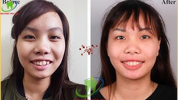 Hành trình tháo niềng: tìm lại sự tự tin vốn có