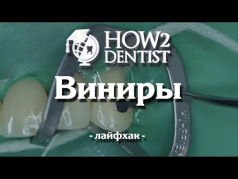 Как фиксировать виниры, лайфхаки / How to Dentist