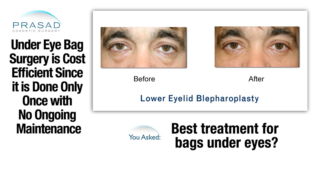 Share more than 75 bags under eyes surgery cost best in.cdgdbentre