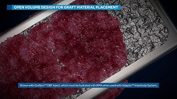 Medtronic  Adaptix™ Interbody System (3D Medical Animation)