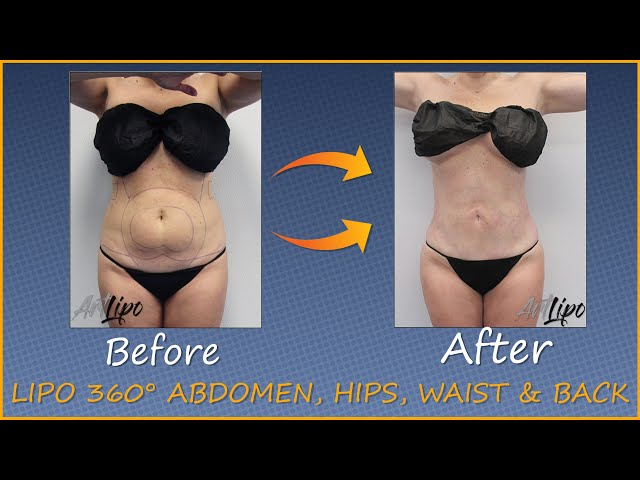 Lipo 360° Abdomen, Hips, Waist, Back, Immediate Results, Awake Tumescent  Liposuction