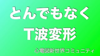 とんでもなくＴ波が変形している症例