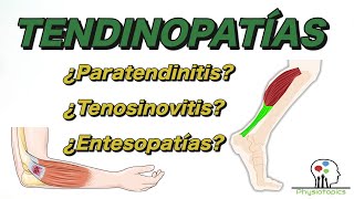 ¿Tendinitis o tendinosis? Causas y tratamiento de las tendinopatías ¿Tendinitis o tendinosis? Causas y tratamiento de las tendinopatías
