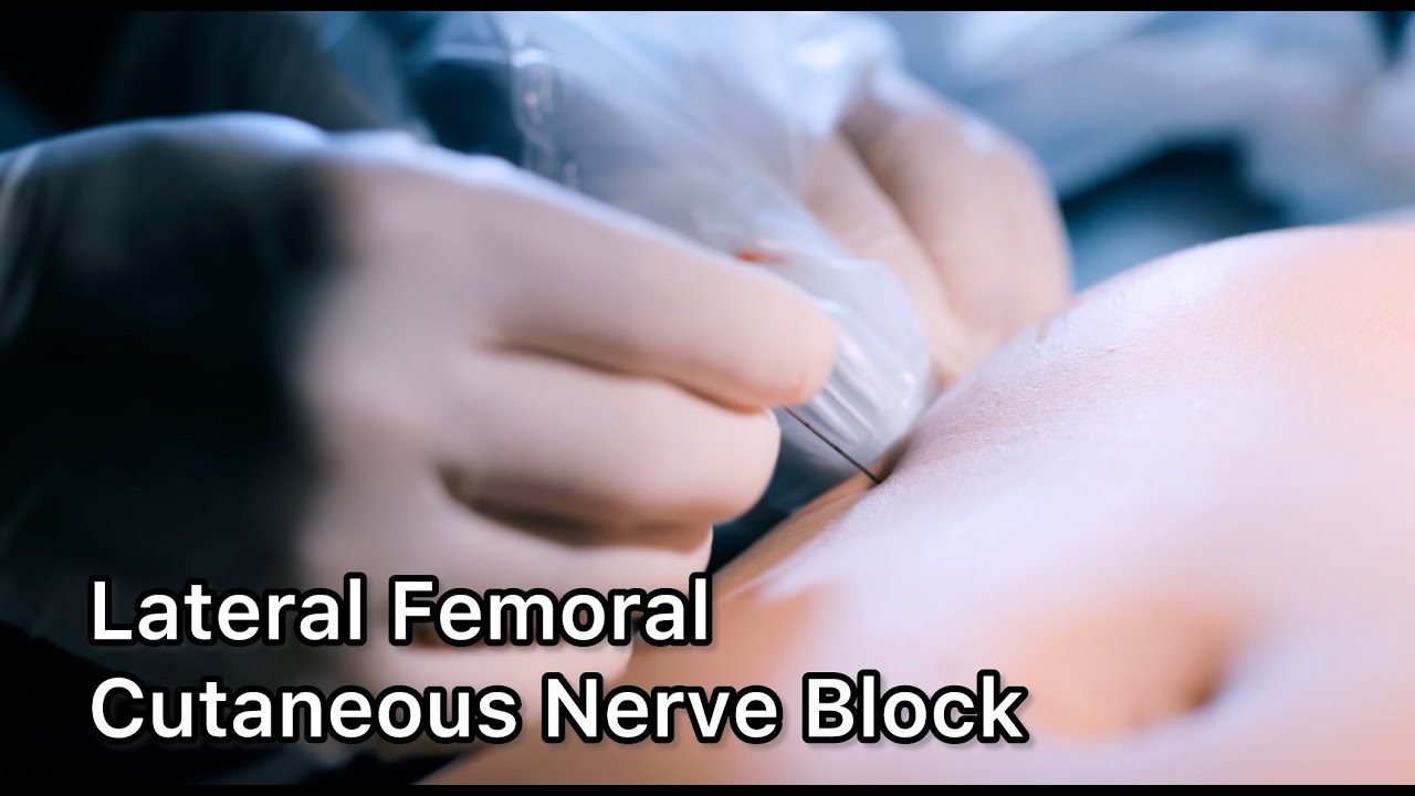 How to Find the Lateral Femoral Cutaneous Nerve [Education]／LFCN block ...
