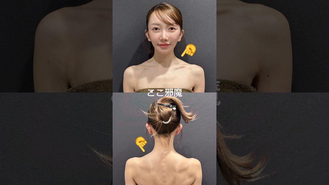 肩こり ボトックス 保険 適用