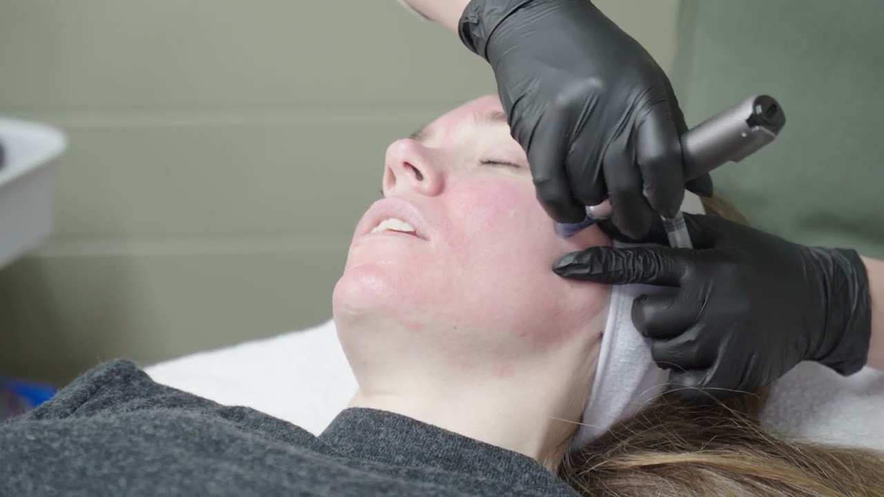 Microneedling