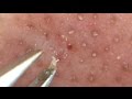 【No.7】I try to take the keratin plug.角栓連続抜き!
