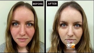 Dr. Max Gomez: Rosacea Treatment