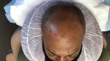 Scalp Micropigmentation in the DMV area!!! Scalp Allure
