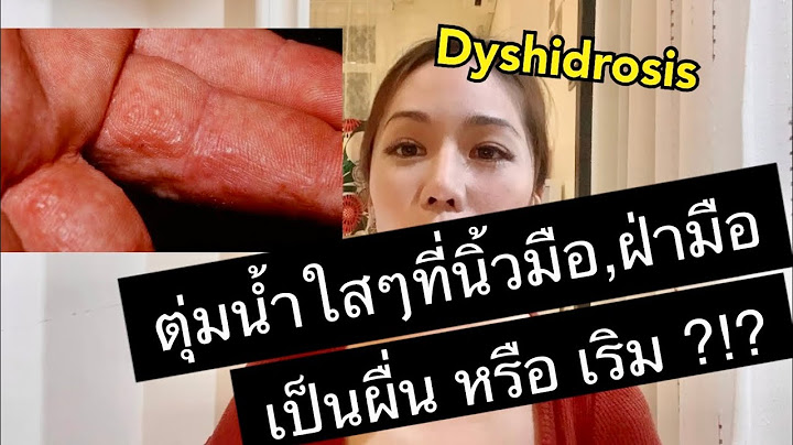 ม อาการต มใสๆข นตามห ว-ลำต วเก ดข นหน าร อน