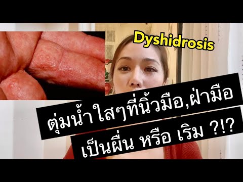 วีดีโอ: วิธีการรักษากลาก Dyshidrotic: 12 ขั้นตอน (พร้อมรูปภาพ)