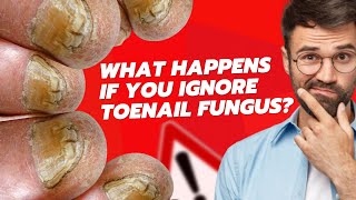 WHAT HAPPENS IF YOU IGNORE TOENAIL FUNGUS?