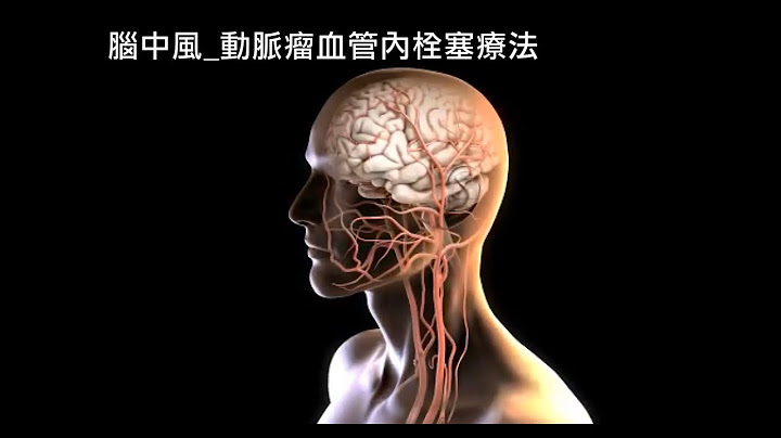 腦中風治療-動脈瘤血管內栓塞療法與顱內動脈取栓術 - 天天要聞