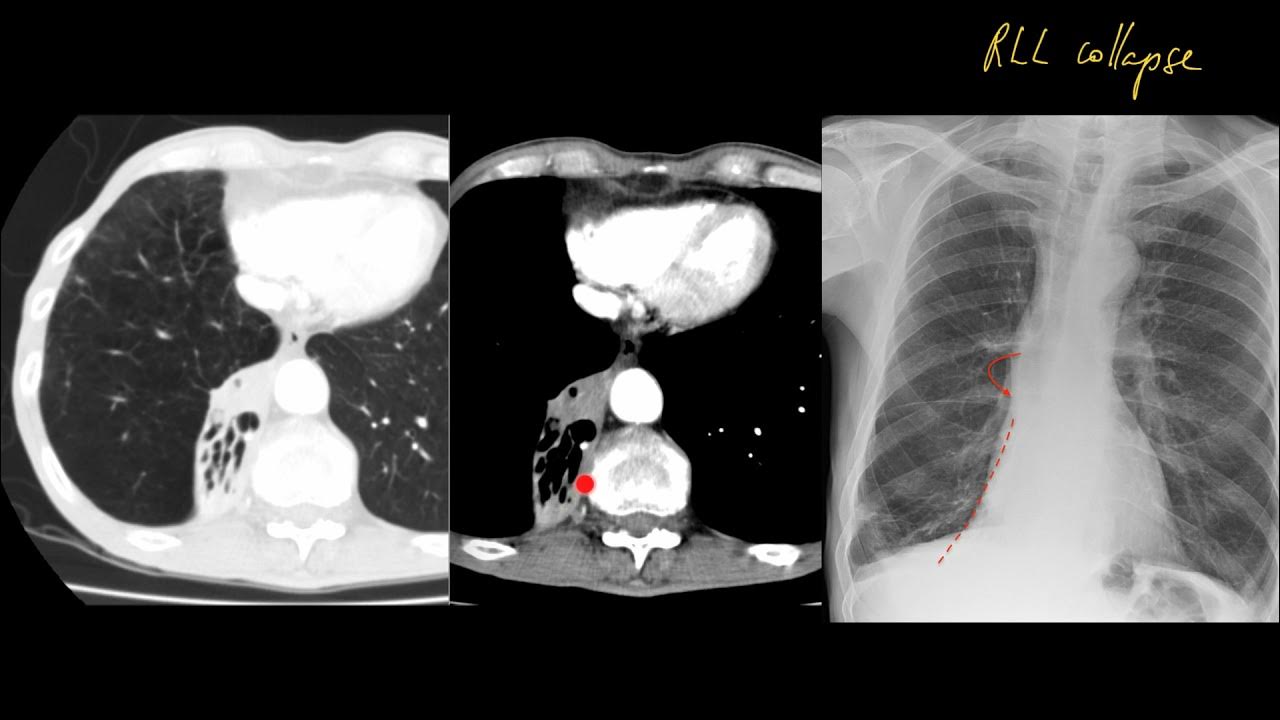 That chest xray looks normal, why is it in my exam? How to approach