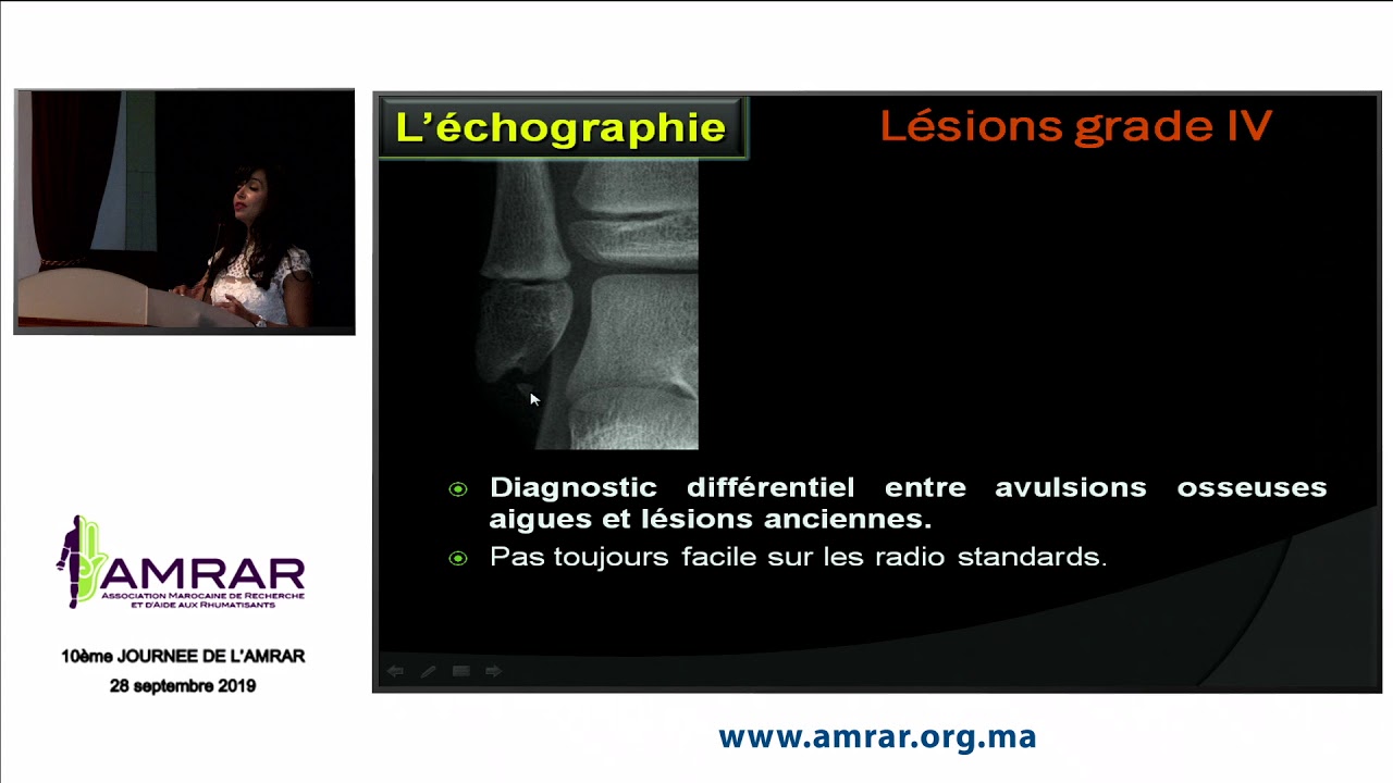 AMRAR - Exploration par imagerie des ligaments latéraux de la cheville, Siham TIZNITI 2/2 - 280919