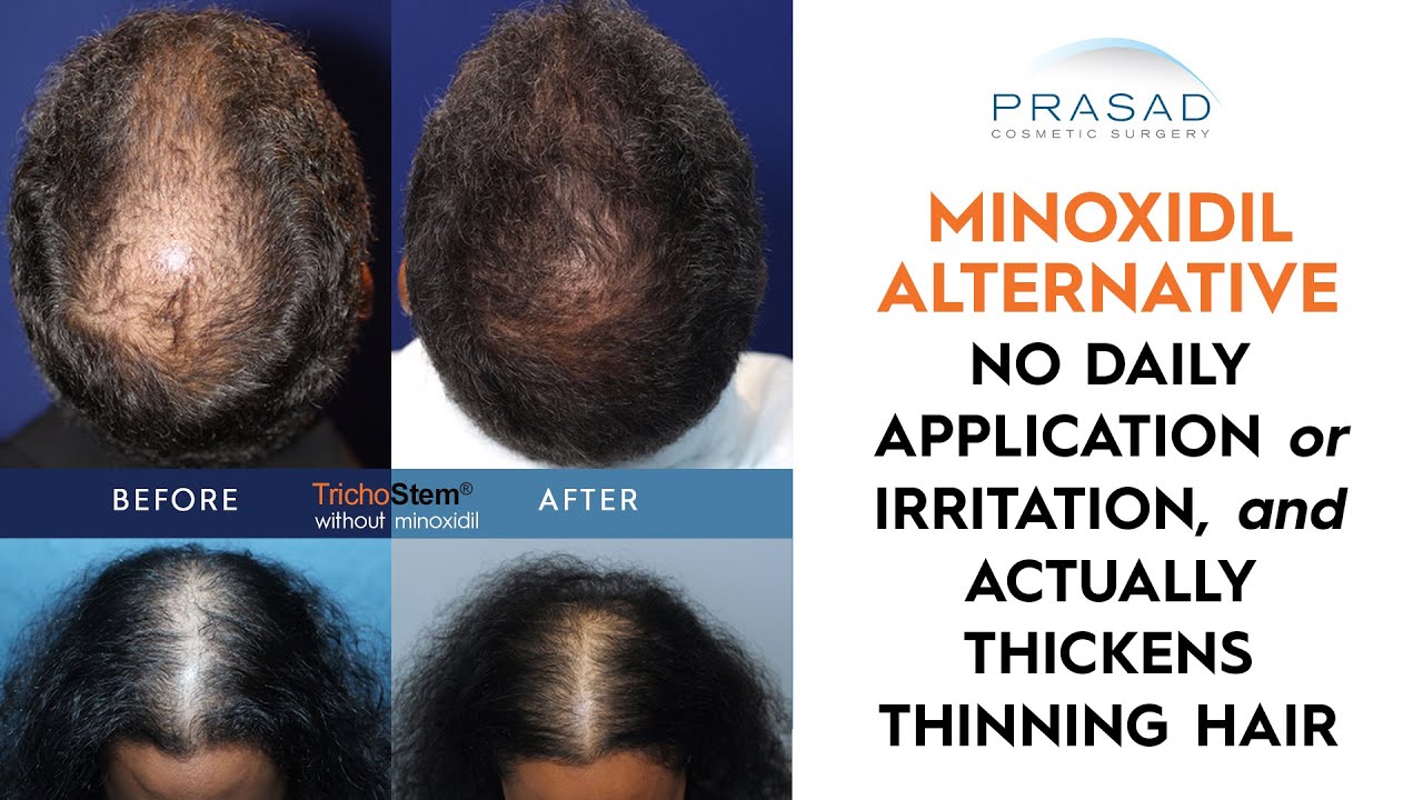 Limitations of Minoxidil, and Why it's Not Needed After the TrichoStem Hair  Regeneration Treatment - YouTube