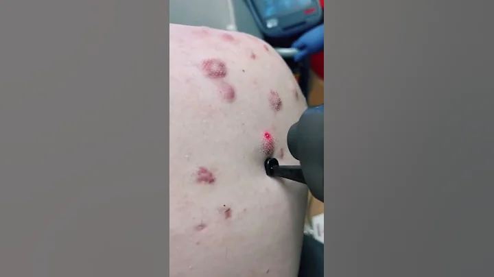 Treatment for keloid scarring from severe acne. #shorts - DayDayNews