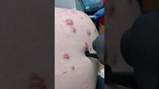 Treatment for keloid scarring from severe acne. #shorts