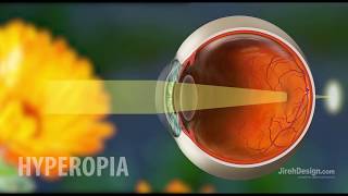 Hyperopia | Farsightedness Explained [HD]