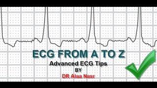 Ecg Tips And Tricks Items ,Dr Alaa A. Nasr 2015